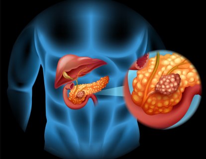 İleri evre pankreas nöroendokrin tümör tedavisi için surufatinib