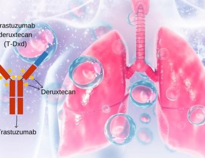 İlk Kez HER2 Mutant Akciğer Kanserinde Bir İlaç FDA Onayı Aldı: Trastuzumab Deruxtecan