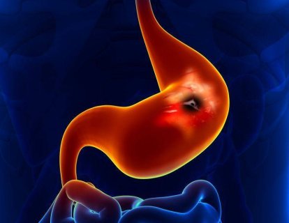 İlk olarak mide kanseri tedavisi için bir immünoterapi ilacı FDA onayı aldı