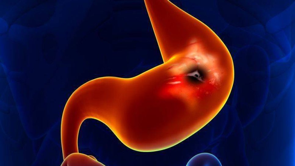İlk olarak mide kanseri tedavisi için bir immünoterapi ilacı FDA onayı aldı