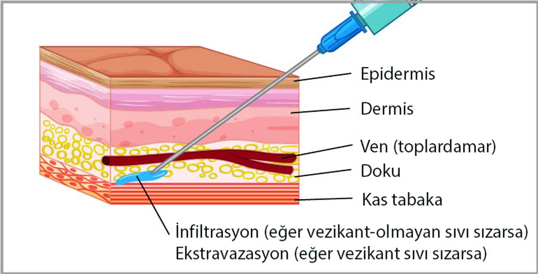 What are infiltration and extravasation?