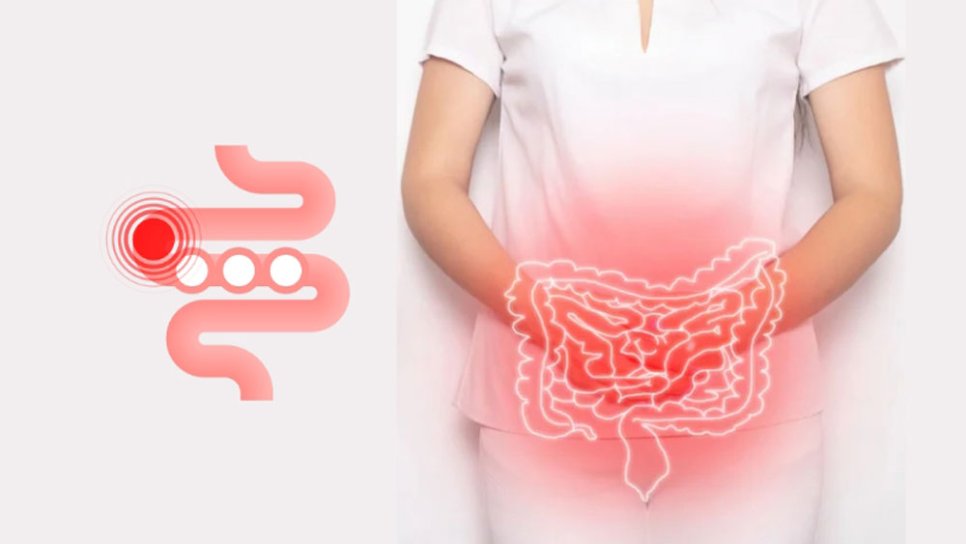 İnflamatuar Bağırsak Hastalığının, Erken Yaşta Başlayan Kolon-Rektum Kanserinde Rolü Var