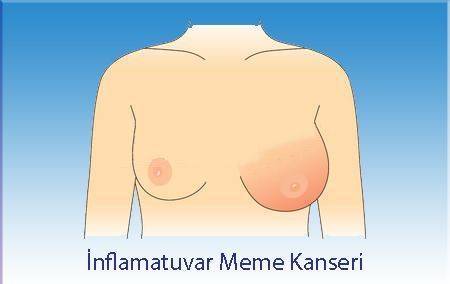 inflamatuvar meme kanseri belirtisi 196208