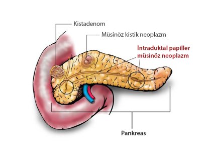 İntraduktal Papiller Müsinöz Neoplazm Nedir? Pankreas Kanalında Gizemli Tümör