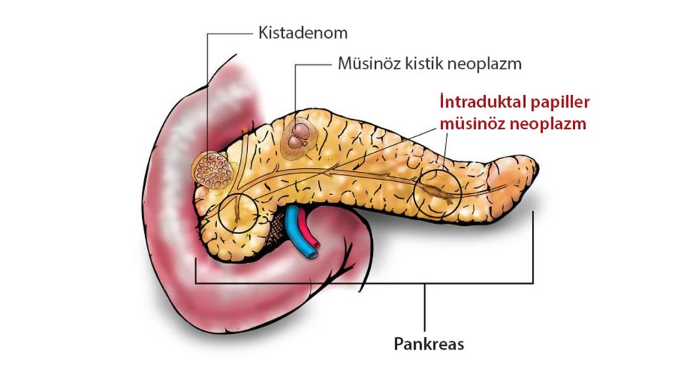 İntraduktal Papiller Müsinöz Neoplazm Nedir? Pankreas Kanalında Gizemli Tümör