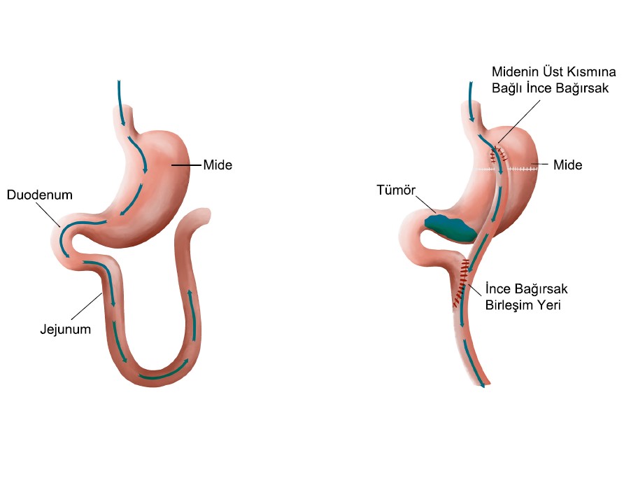 jejunostomi gastrojejunostomi g tupu j tupu mustafa ozdogan drozdogan 99975