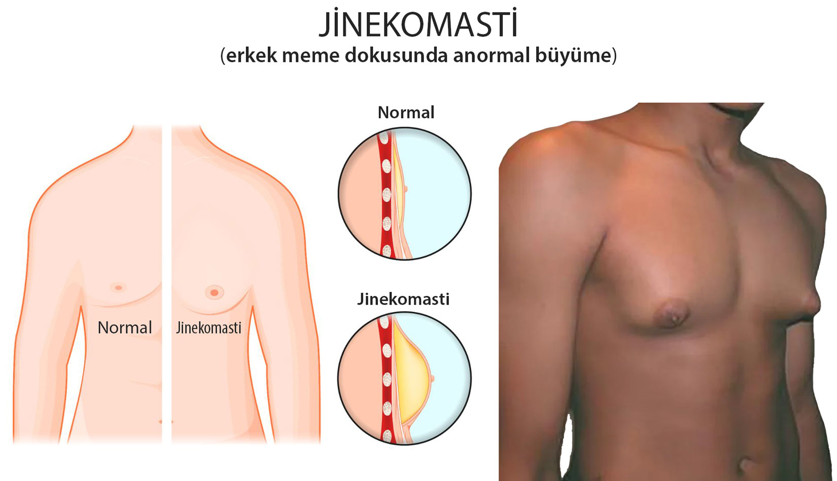 What is gynecomastia? Visual explanation of abnormal male breast tissue enlargement