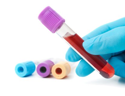 Kan Testi ile Alzheimer Hastalığında Erken Tanı