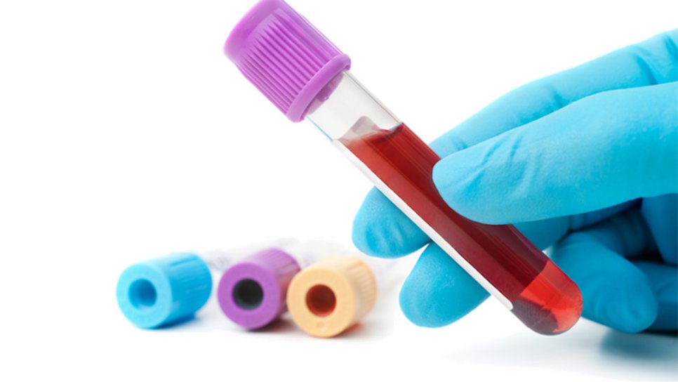 Kan Testi ile Alzheimer Hastalığında Erken Tanı