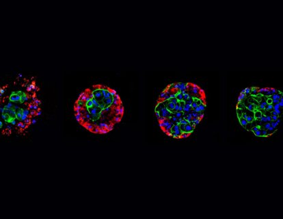 Kanser İlaçlarına Direnç Tersine Çevrilebilir – En Zorlu Kanserler Hedef Alınıyor