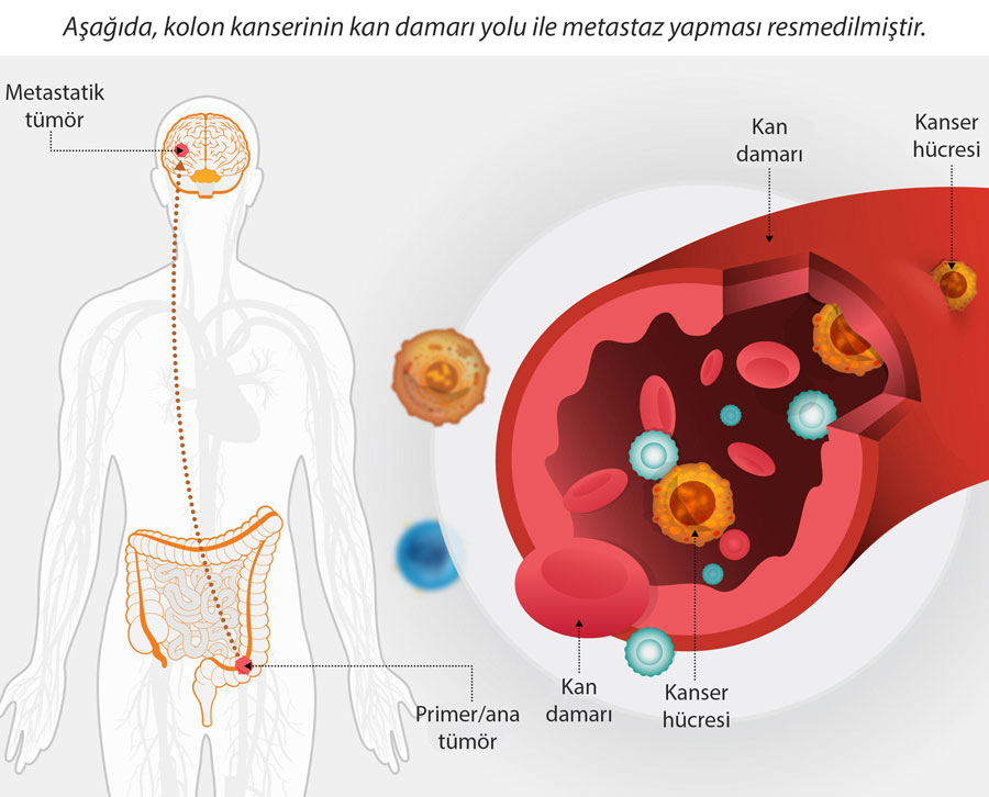kanser nasil metastaz yapar metastatik tumor nedir kan yoluyla yayilma 995623