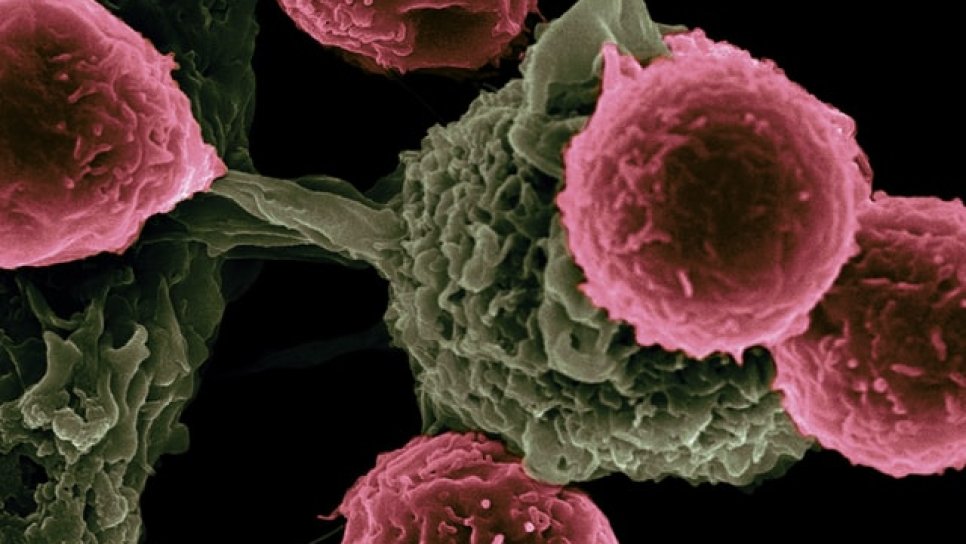 5 wichtige Entwicklungen bei Krebs – AACR-Jahrestagung 2021