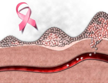 Kanserin Evresi Nedir? Tümörün Tedaviye Cevap Verdiği Nasıl Anlaşılır?