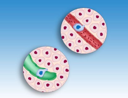 Kanserin Metastaz Yapmasını Baskılayıcı Bir Molekül Keşfedildi