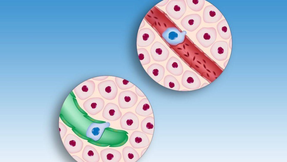 Kanserin Metastaz Yapmasını Baskılayıcı Bir Molekül Keşfedildi