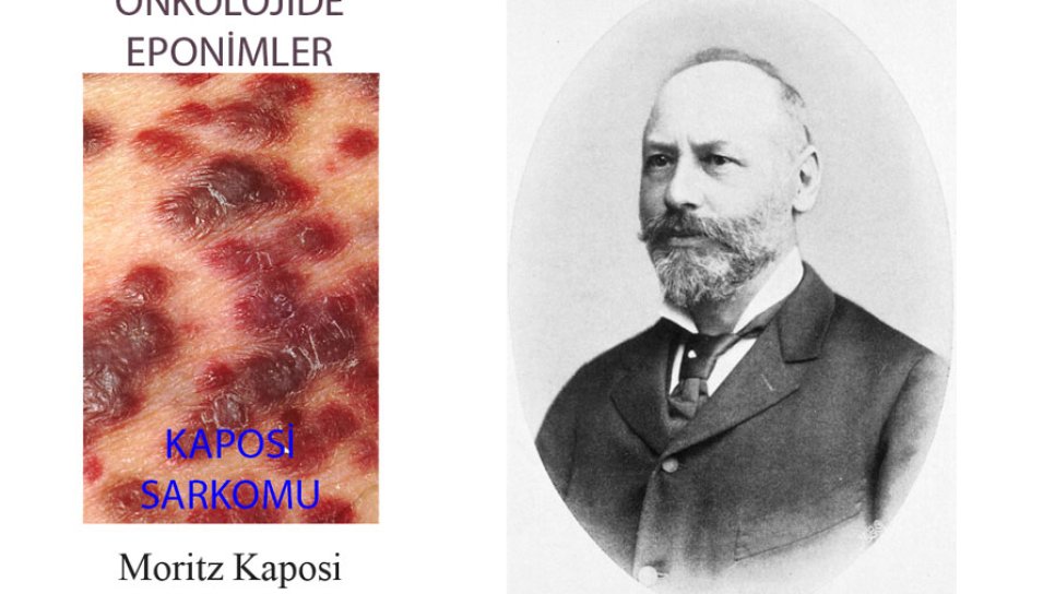 Kaposi sarkoması nədir? Tarixi və müalicədə son vəziyyət