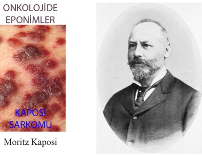 Kaposi Sarkomu nedir? Tarihi ve Tedavisinde Gelinen Son Nokta