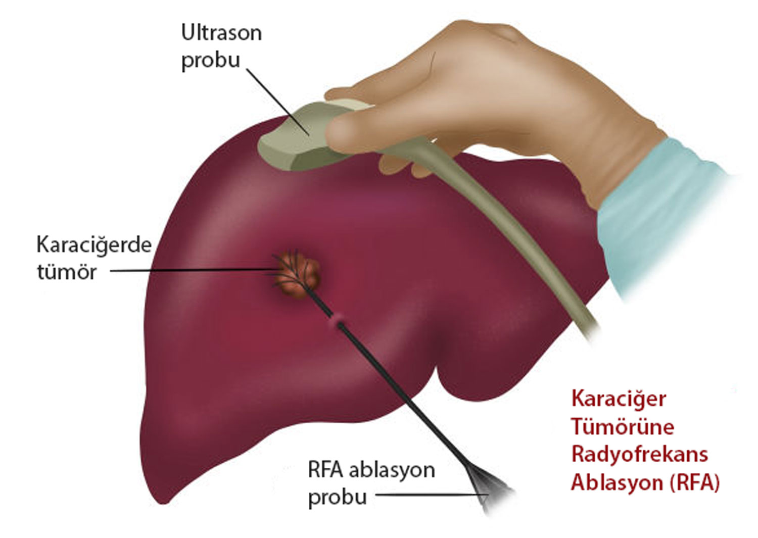 Radiofrequenzablation RFA beim hepatozellulären Leberkrebs HCC