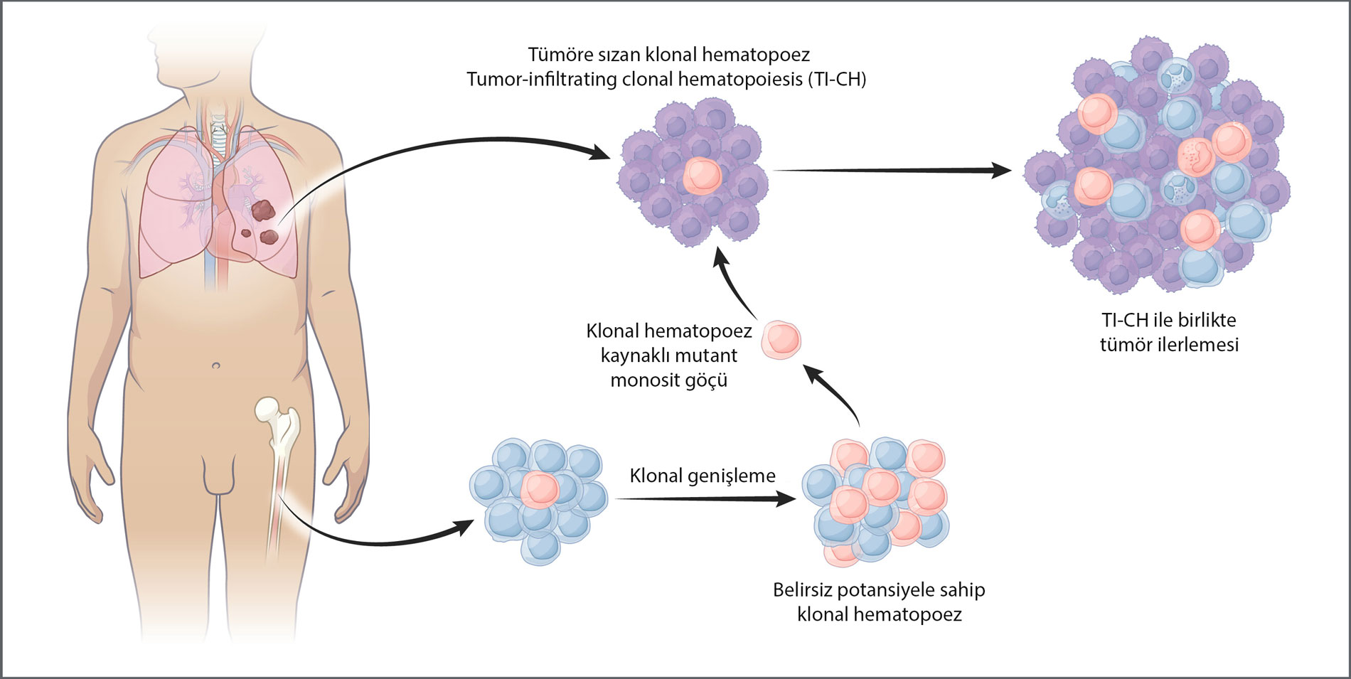 în procesul care începe în măduva osoasă, unele celule sanguine acumulează mutații genetice legate de vârstă și pot deveni ulterior hematopoieză clonală infiltrantă tumoral