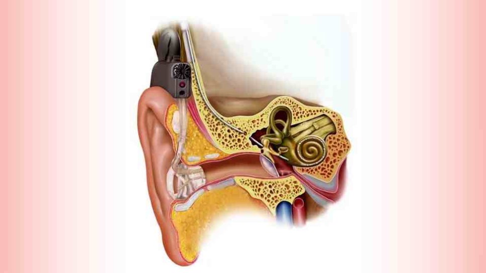 Cochlear Implants 1977 – The Bionic Ear