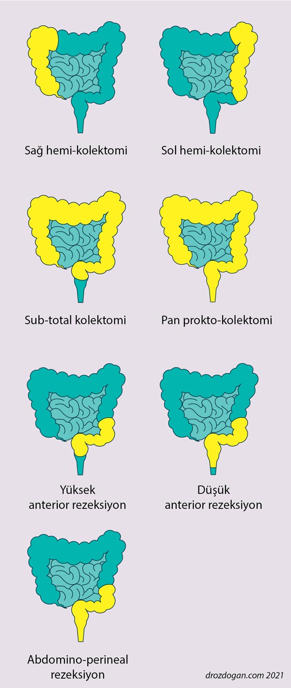 types of colectomy hemicolectomy total LAR low anterior resection transverse abdominal perineal proctocolectomy
