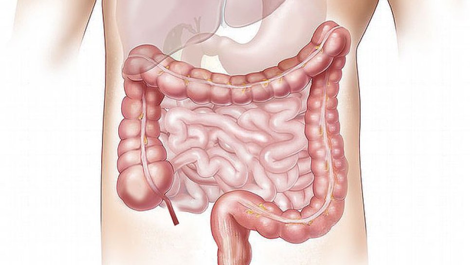 What Is a Colectomy? What to Know About Colon Cancer Surgery