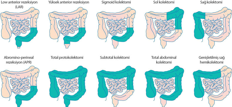 Die Verfahren der kolorektalen Dickdarmkrebsoperation richten sich nach Lage und Stadium des Tumors: Kolektomie, LAR beziehungsweise tiefe anteriore Resektion und APR