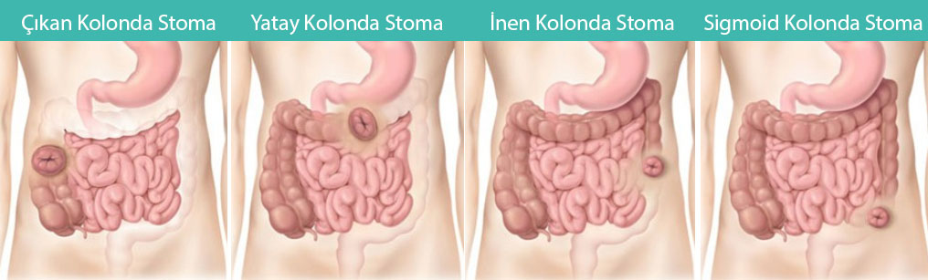 types of colostomy ascending transverse descending sigmoid stoma