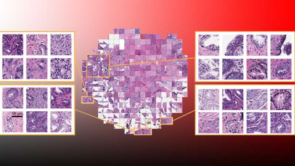 Kanserde Patoloji Sonucu İçin Kompütasyonel Karar Destek Sistemleri Yaygınlaşıyor