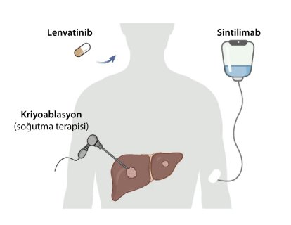 Krioablasyon + İmmünoterapi + Lenvatinib: Safra Yolu Kanserinde Yeni Üçlü Sinerji