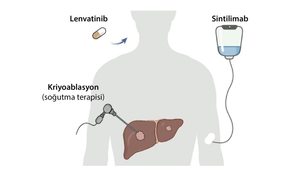 Krioablasyon + İmmünoterapi + Lenvatinib: Safra Yolu Kanserinde Yeni Üçlü Sinerji