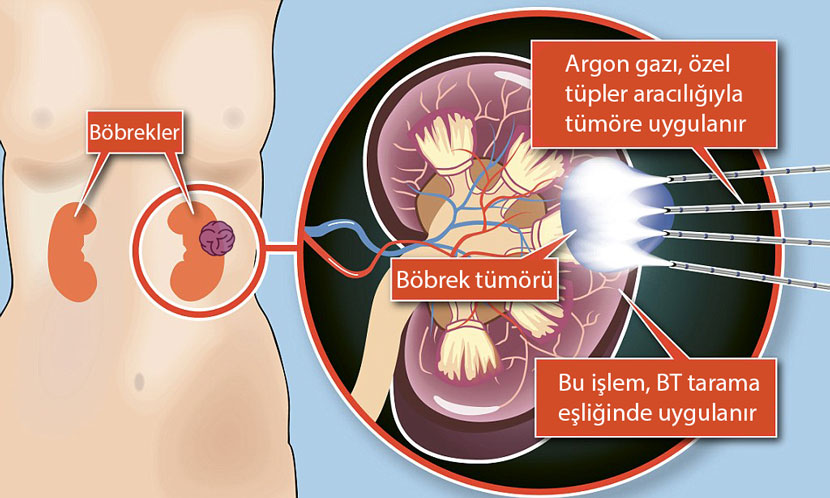 How cryoablation freezing treatment works: mechanism of action