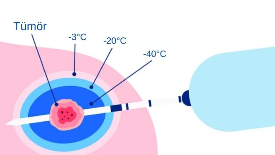 What Is Cryoablation (Freezing Treatment)? Which Cancers Is It Suitable or Unsuitable For?