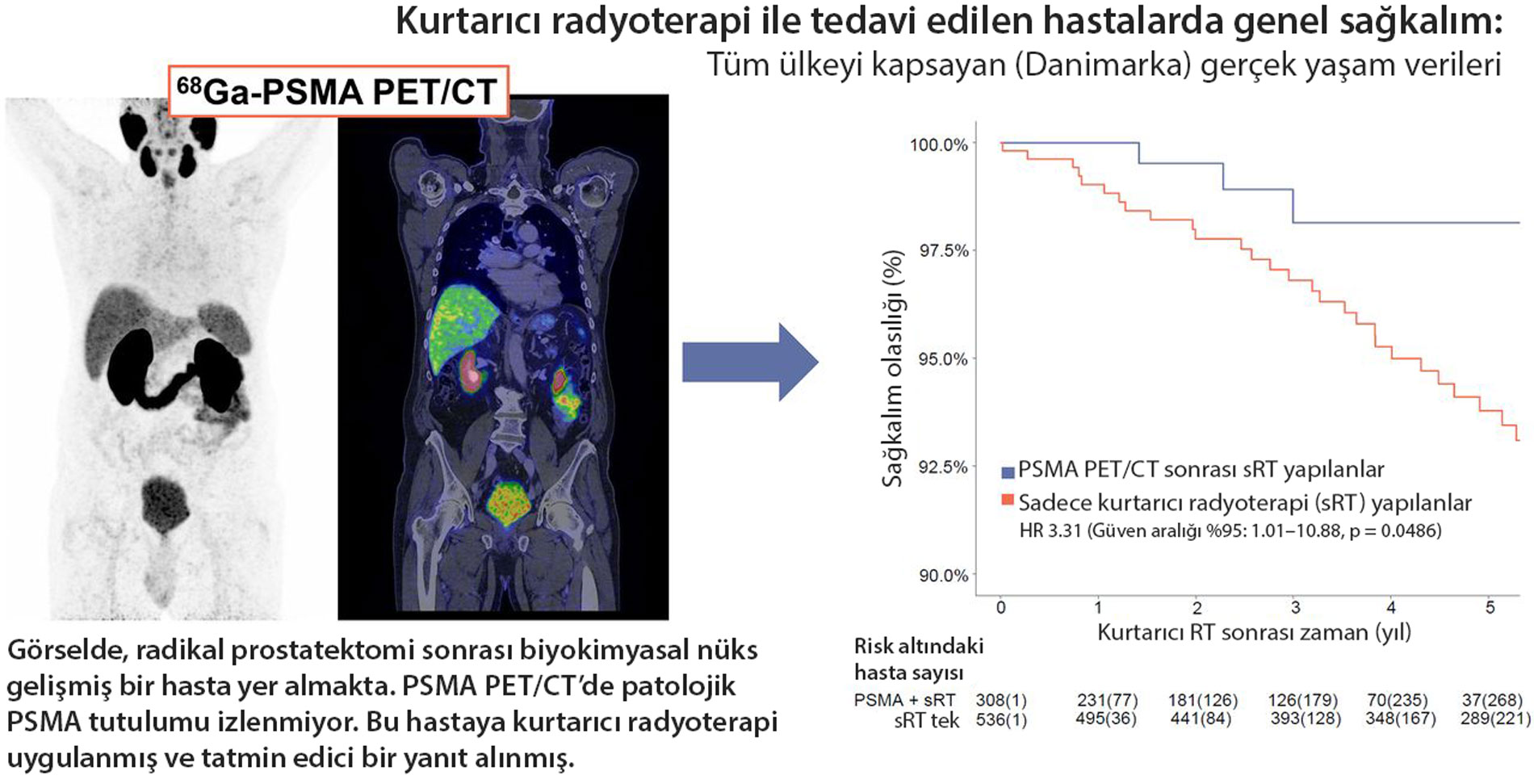 kurtarici radyoterapi ile tedavi edilen hastalarda genel sagkalim tum ulkeyi kapsayan gercek yasam