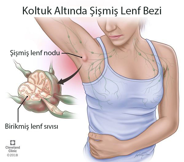 lenf bezi sismesi nasil olur 422680