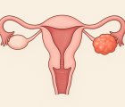 Liposomal Doksorubisin ve Bevacizumab Tedavi Protokolü (Over)