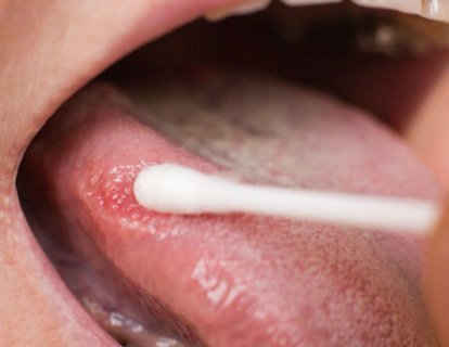 Lökoplaki Nedir? Neden olur? Belirtileri ve Tedavisi