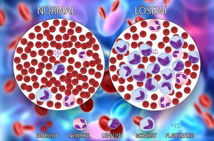 losemi ve normal kan farki 506042