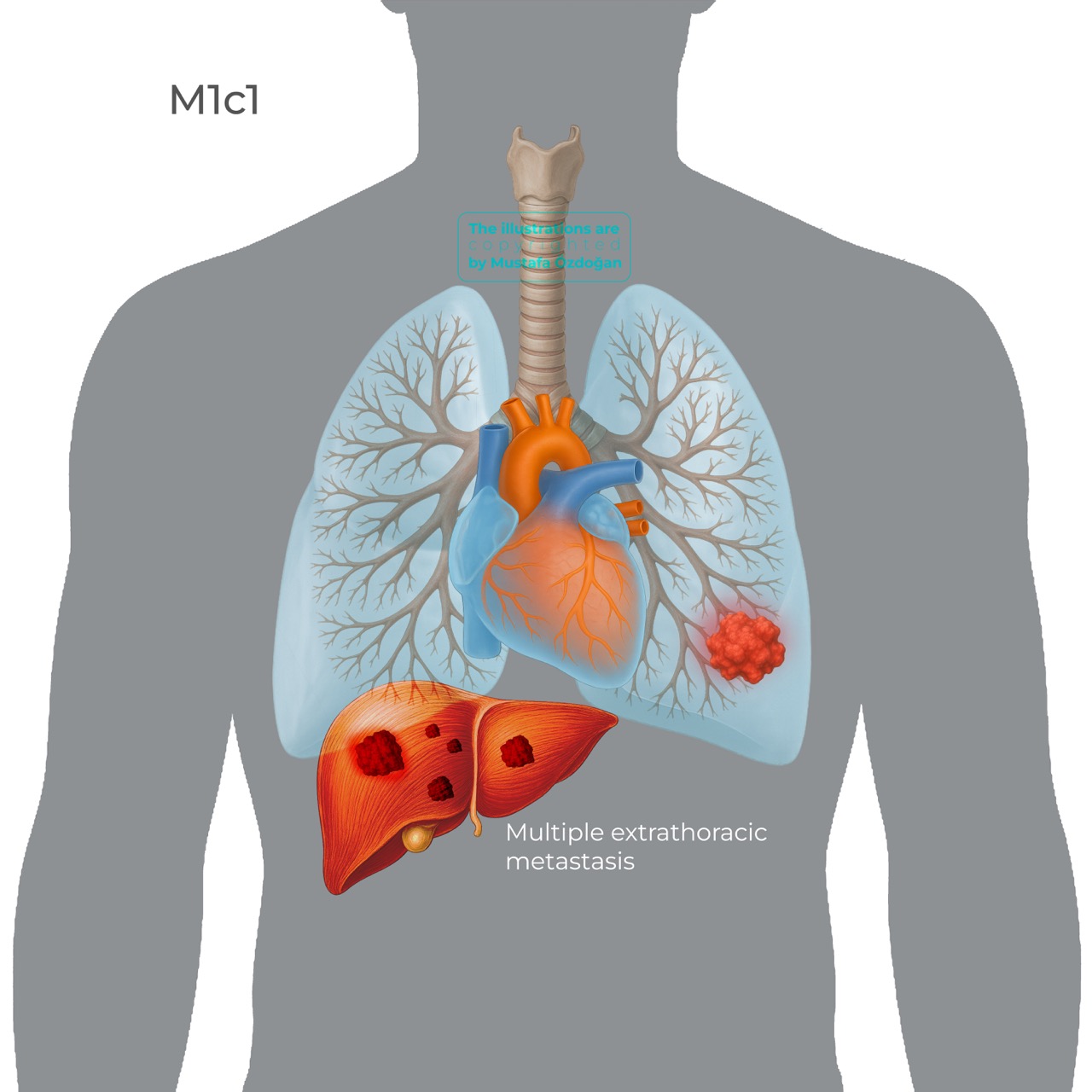 lung cancer tnm9 m1c1 696484