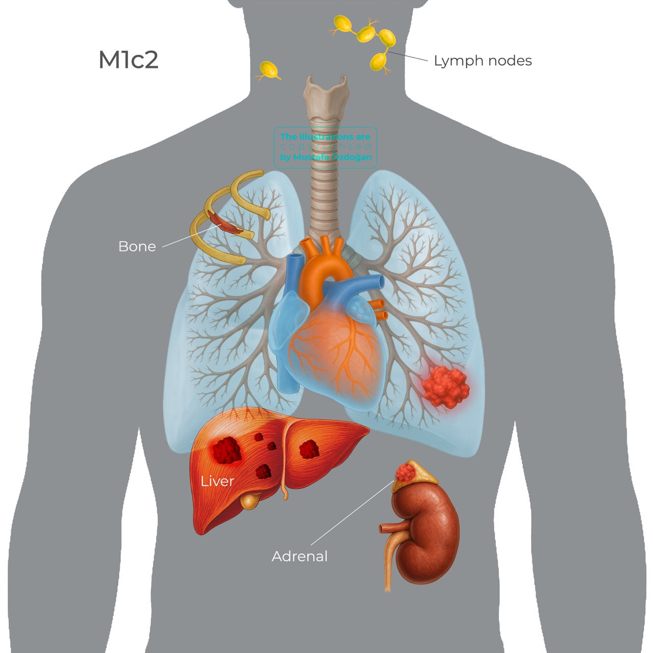 lung cancer tnm9 m1c2 593838