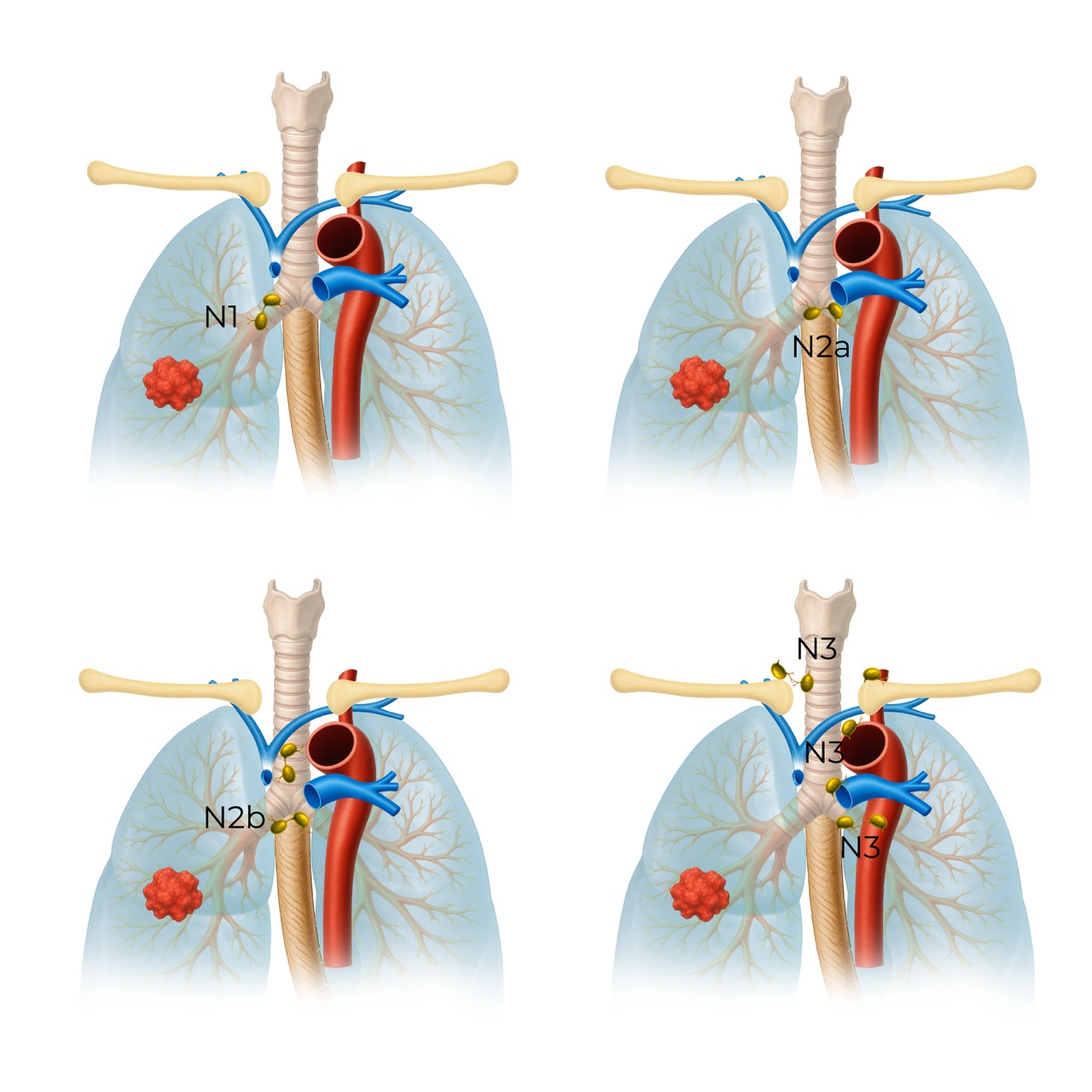 lung cancer tnm9 n stagin n1 3 780008