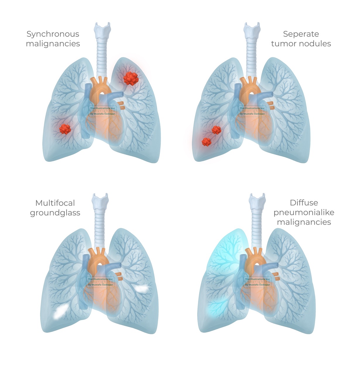lung cancer tnm9 staging multiple types of malignancy 785506
