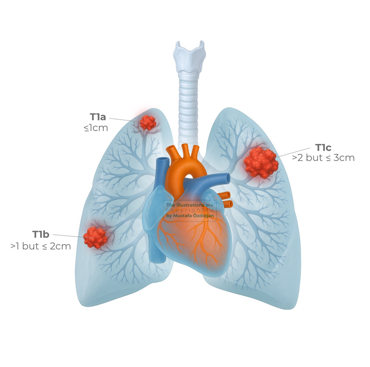 lung cancer tnm9 t1a b c 976058