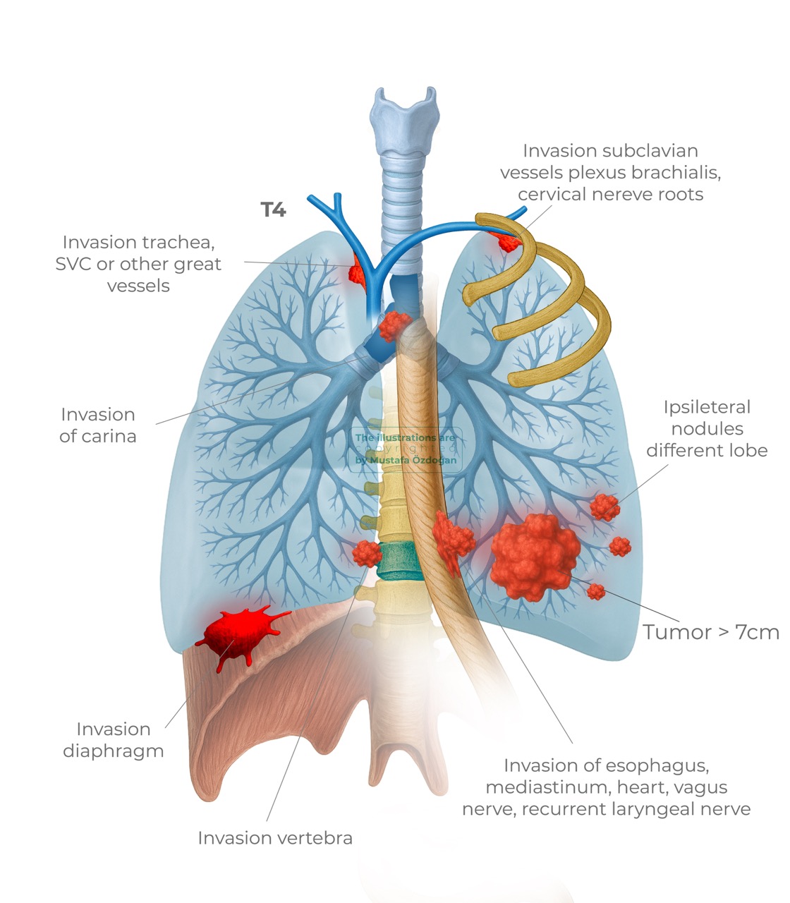 lung cancer tnm9 t4 328315