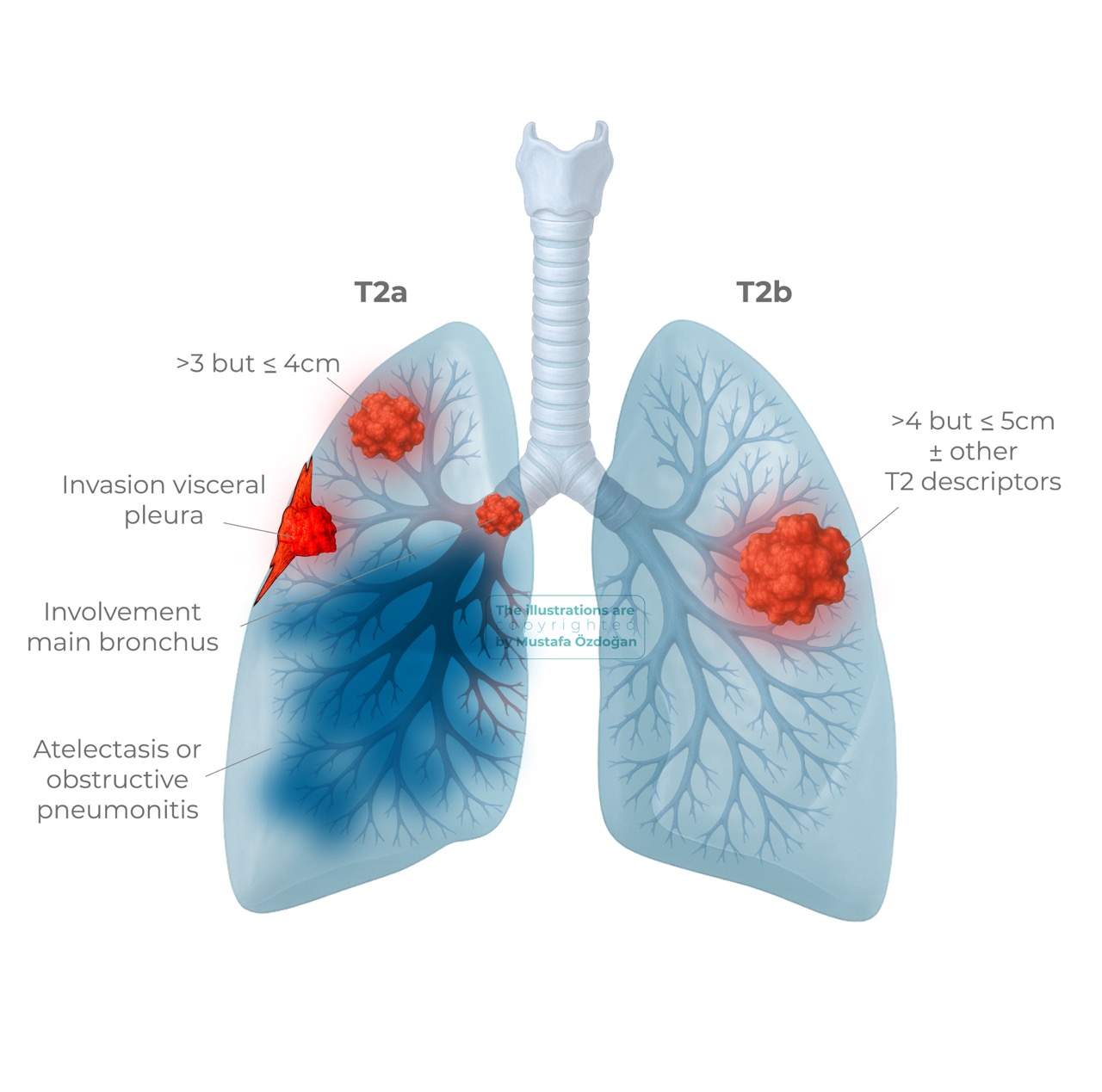 lung cancer tnmp t2a b 594029