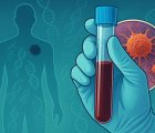 Melanomda Nüks Riski: Kandaki Tümör DNA’sı (ctDNA) Yeni Bir Yol Gösterici
