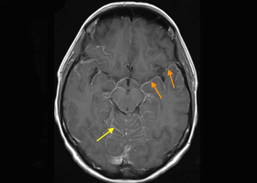Leptomeningeale metastatische Erkrankung bei Brustkrebs