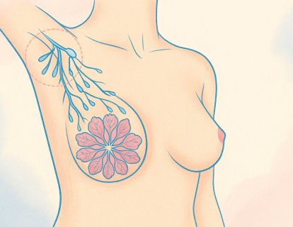 Meme Kanseri Tedavisi Sonrası Koltuk Altı Ameliyatı Gerekli mi?