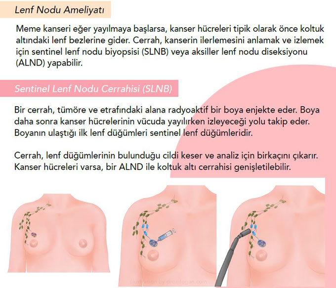 sentinel lymph node biopsy in breast cancer
