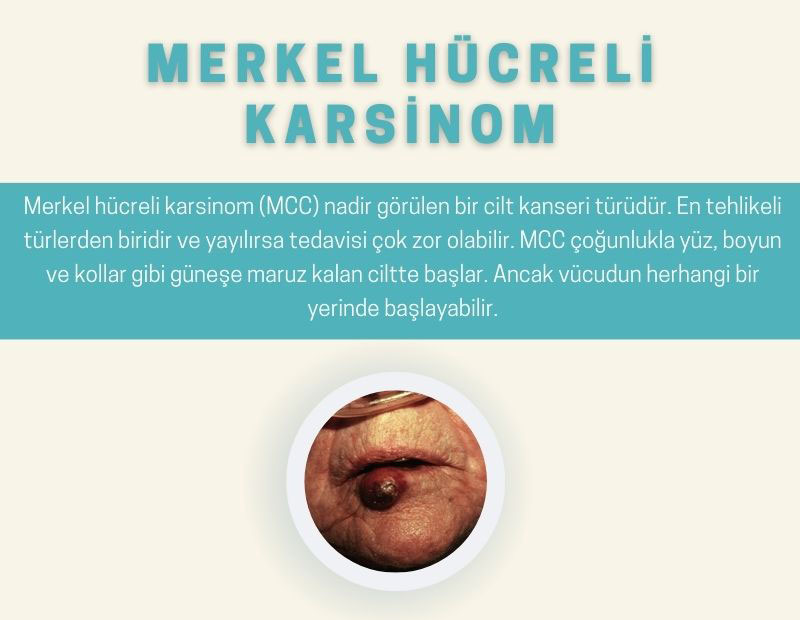merkel hucreli karsinom cilt kanseri fotograflari 846873